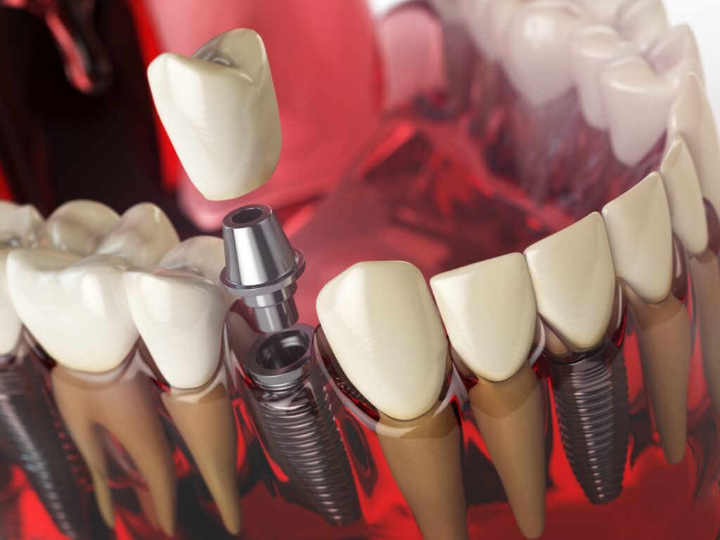 implantes