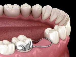 Mantenedores de espaço são dispositivos odontológicos utilizados principalmente na odontopediatria (odontologia para crianças) para preservar o espaço na arcada dentária quando um dente de leite (decíduo) é perdido antes da hora ideal.